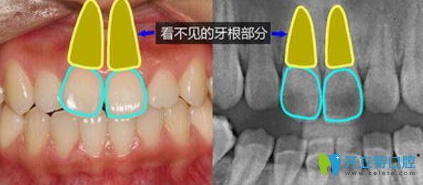 正畸过程中牙齿移动原理