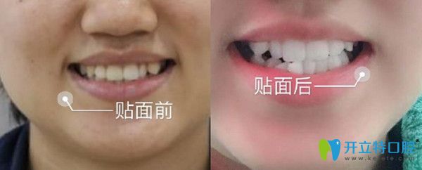 牙齿美容修复前后变化图 牙齿美容修复前后变化图