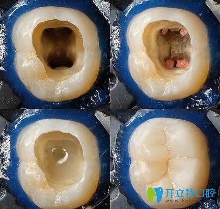 牙齿缺损后补牙过程图解