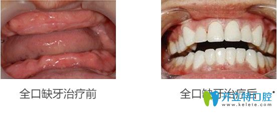 65岁王先生做完立得用全口种植牙后对比效果