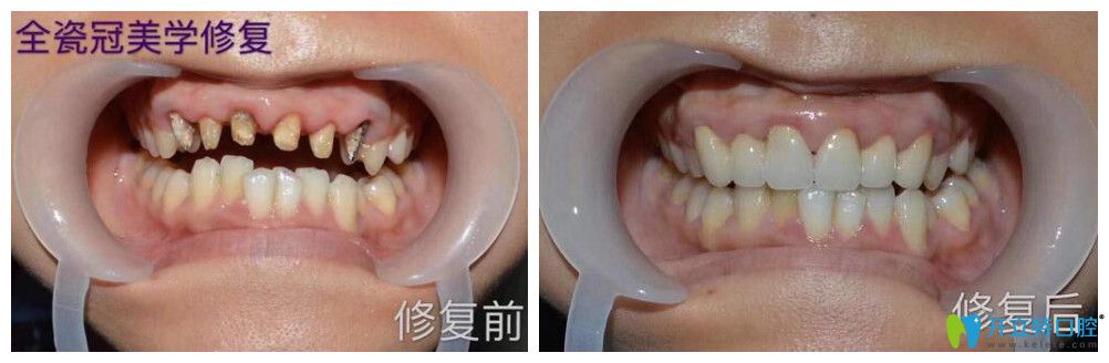 逸盛口腔口腔烤瓷牙失败全瓷牙修复案例前后效果对比