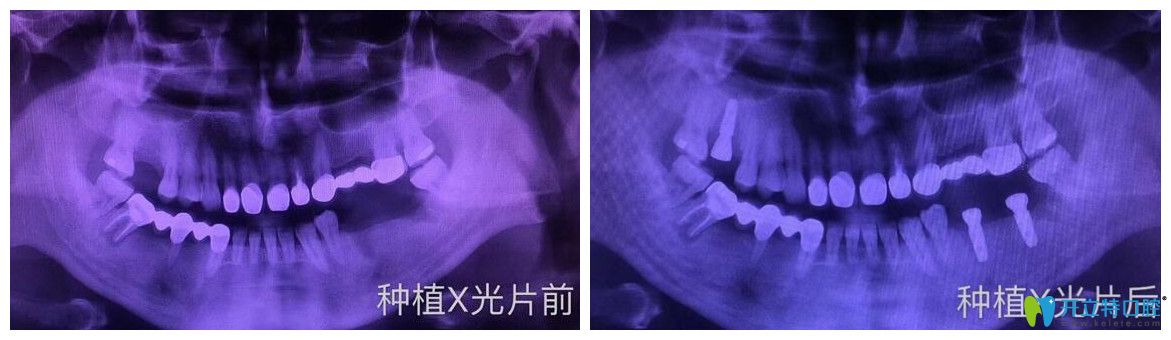 逸盛口腔口腔多颗牙缺失即刻种植案例