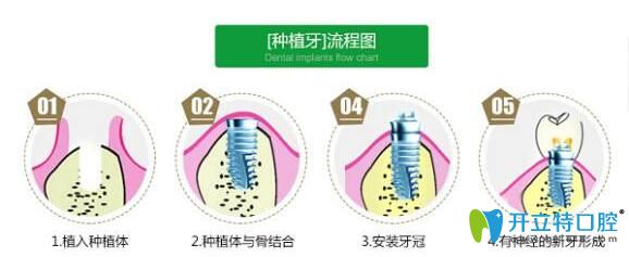 谢精文医生科普：种植牙疼不疼