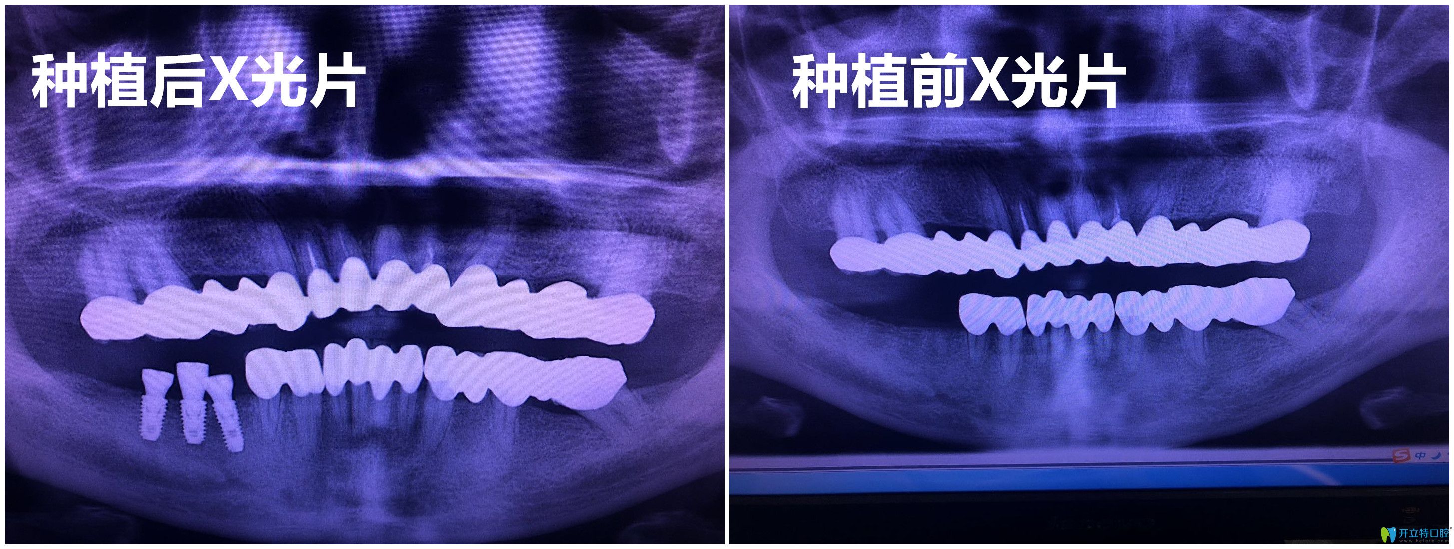 杭州逸盛口腔谢精文种植牙案例