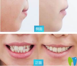 衡阳美莱口腔黄安医生牙齿矫正效果对比图