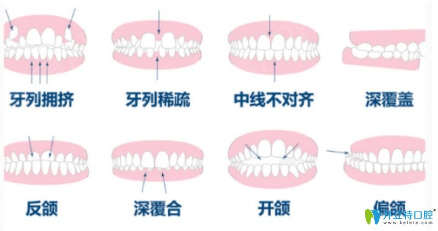 什么是上下牙齿咬合不齐