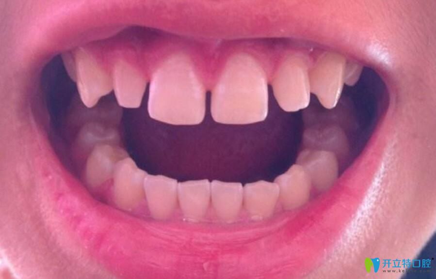  树脂补门牙有缝隙后悔了，我该如何补救呢？