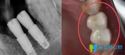 种植体歪了可以做牙冠调整修复