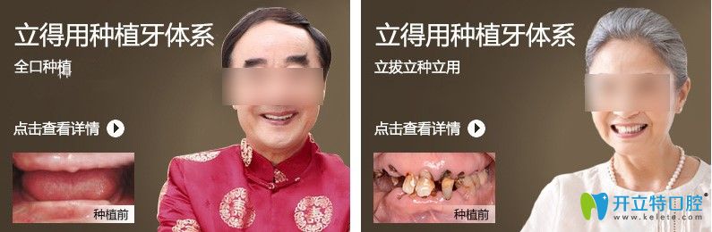 天津中诺立得用种植牙案例效果