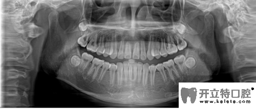 牙齿全景片