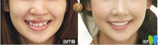 天津中诺口腔成人牙齿拥挤不齐隐适美矫正对比