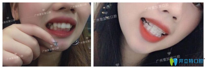 广州壹加壹龅牙、牙齿拥挤不齐矫正案例效果前后对比照片 广州壹加壹龅牙、牙齿拥挤不齐矫正案例效果前后对比照片