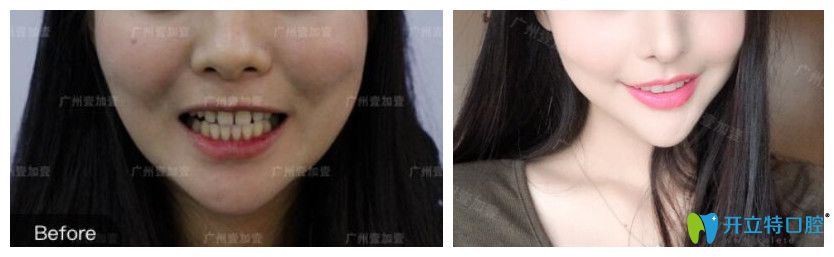牙缝大采用美加瓷贴面修复对比图 牙缝大采用美加瓷贴面修复对比图