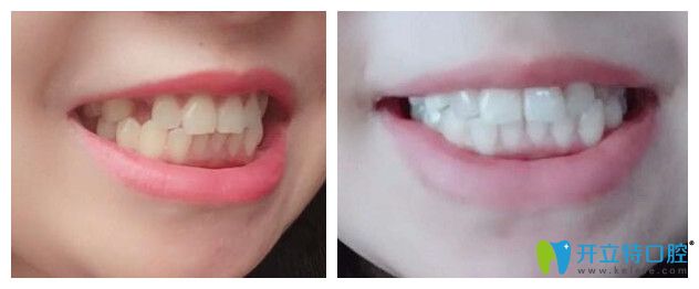 重庆牙博士口腔单颗种植牙案例