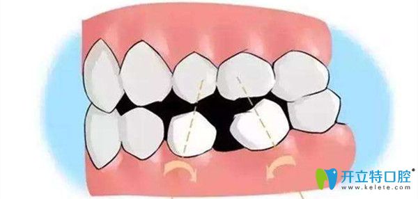 正畸过程中牙齿收缝问题