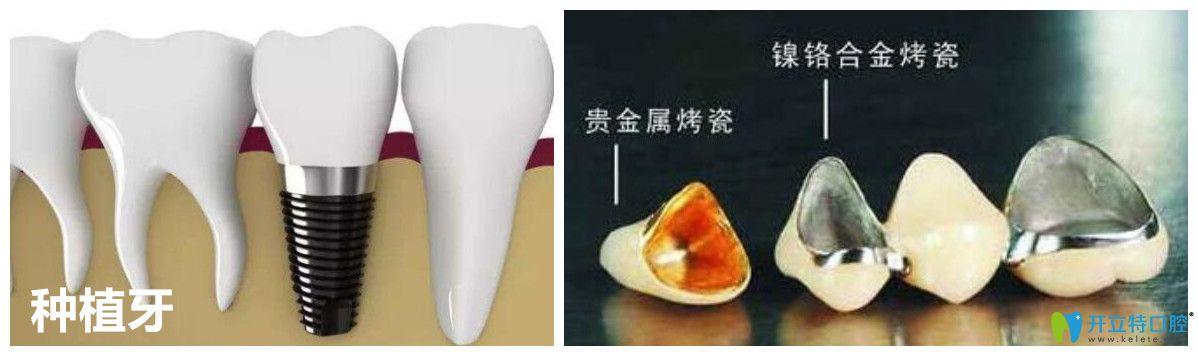 合肥靓美口腔王怀元医生科普：种植牙和烤瓷牙有什么区别