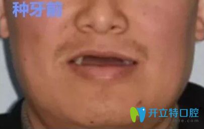 张先生做过全口种植牙后的照片