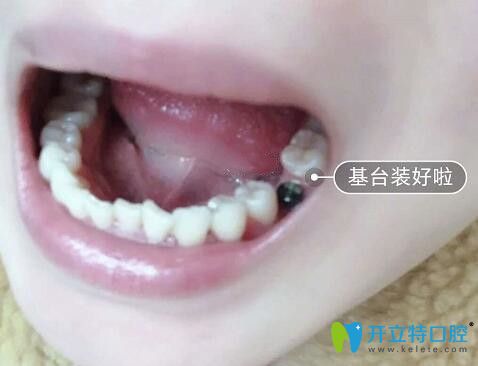 我在广州雅度口腔做种植牙安装基台