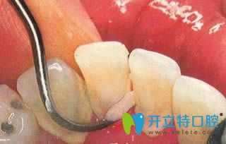 张刚医生提倡牙齿疾病要从定期洗牙做起