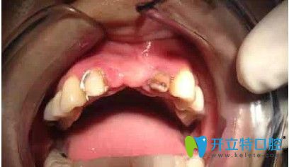 刘女士做种植牙前的照片