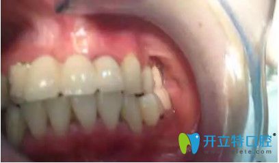 刘女士做完全口种植牙后的效果