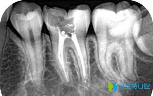 大连博大口腔根管治疗牙片显示图
