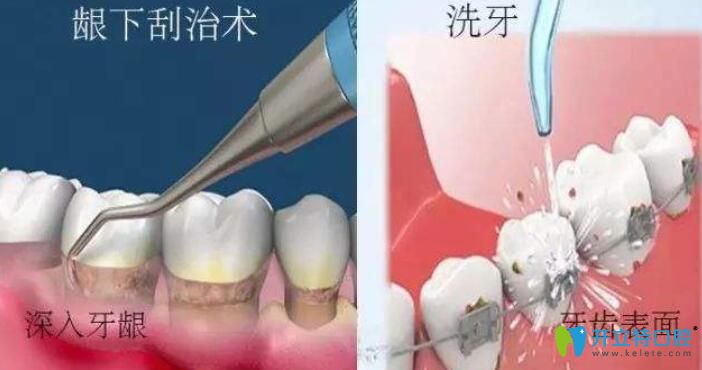 丁晓虹主任讲解：牙周治疗和洗牙的区别
