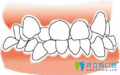 牙齿拥挤在正畸时就需要拔牙矫治