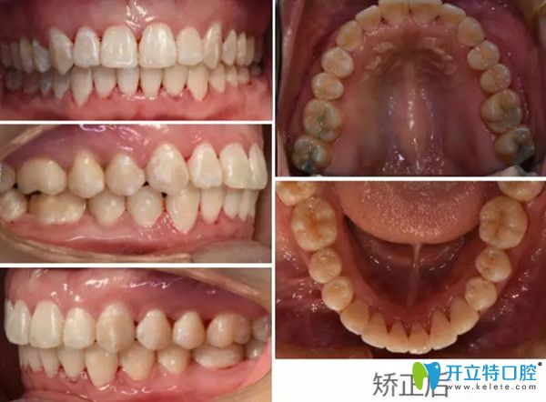 正畸前后对比图