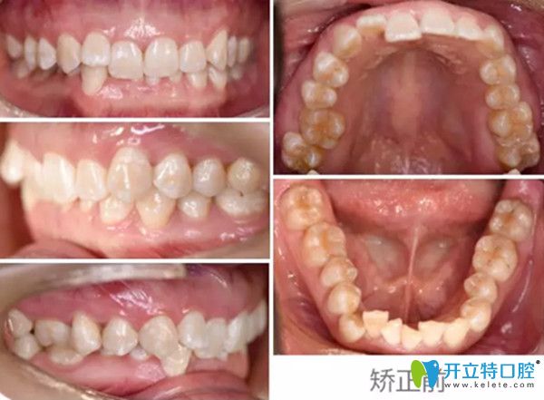牙齿矫正前的照片