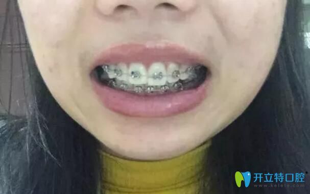 刚戴牙套口内照 刚戴牙套口内照