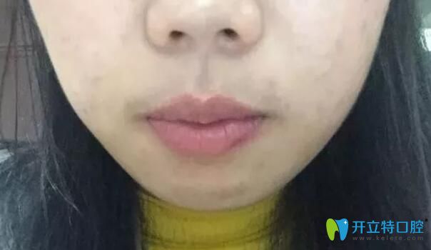在太原华美初戴牙套脸型图 在太原华美初戴牙套脸型图