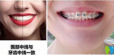 连江县胡明辉口腔讲解牙齿矫正拔牙与不拔牙的区别