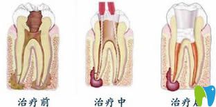 牙体牙髓病的治疗步骤 牙体牙髓病的治疗步骤