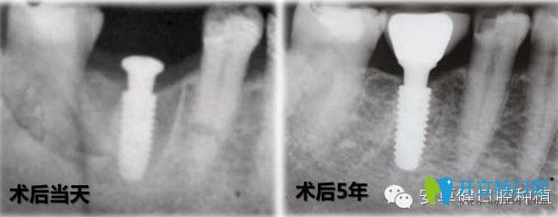 安卓健种植体植入5年后与牙槽骨的融合情况