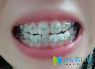 我在上海圣贝口腔做牙齿矫正第10个月