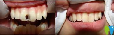 门牙蛀牙修复前后效果图