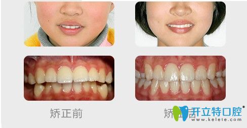成人深覆盖矫正案例效果对比照 成人深覆盖矫正案例效果对比照