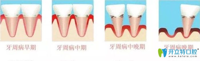 早期和晚期牙周病图片