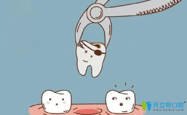 牙齿矫正必须拔牙的话，通常会拔除哪些牙齿？