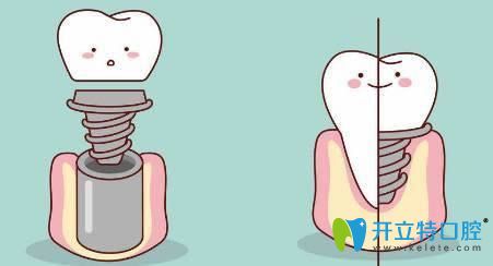 简单介绍种植牙修复基台的作用和种类