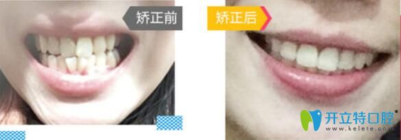 广州哪里做牙齿正畸好?来看广大口腔牙齿矫正前后对比图 广州哪里做牙齿正畸好?来看广大口腔牙齿矫正前后对比图