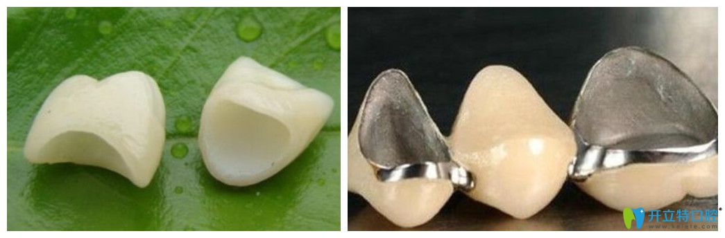 种植牙牙冠的材料主要有哪些呢