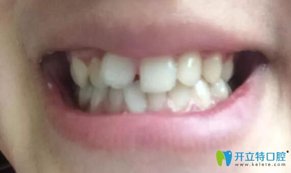 我在深圳阳光口腔做牙齿矫正前的照片