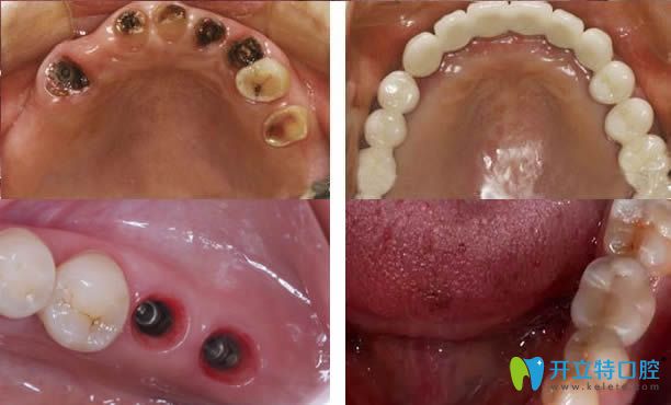 东莞好佰年口腔牙齿种植案例图