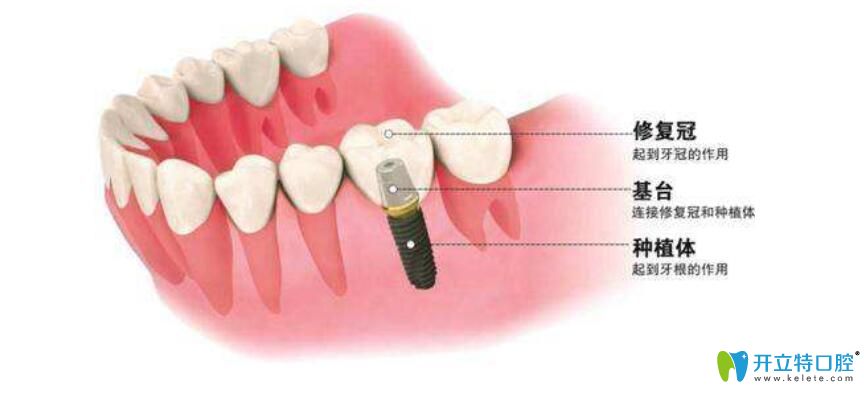 种植牙的构造图