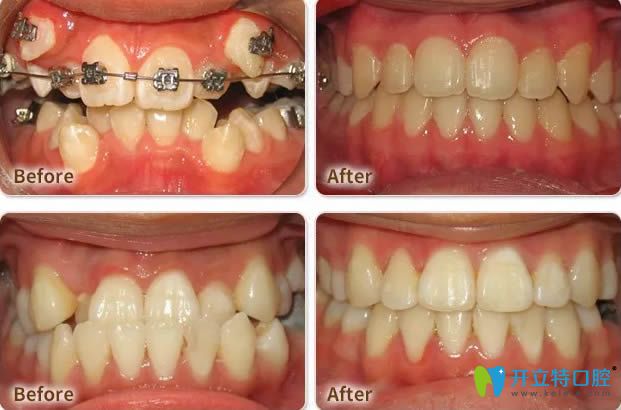 东莞好佰年口腔正畸案例效果图