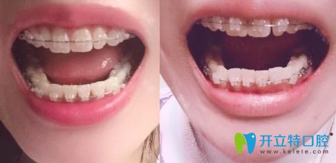杭州时光口腔陶瓷托槽牙齿矫正一年照