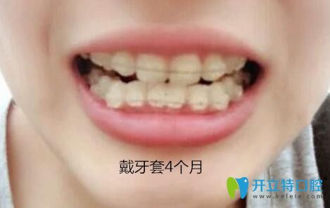 我在梅州中大口腔做牙齿矫正第4个月