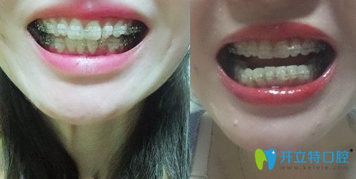 杭州时光口腔矫正牙齿深覆盖4个月照